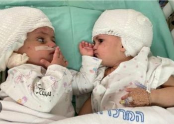 Dokter Muslim Asal Kashmir, Sukses Operasi Bayi Kembar Siam Israel