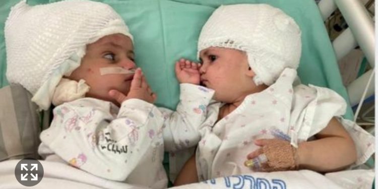 Dokter Muslim Asal Kashmir, Sukses Operasi Bayi Kembar Siam Israel