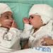 Dokter Muslim Asal Kashmir, Sukses Operasi Bayi Kembar Siam Israel