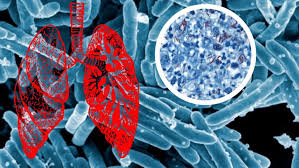 Mentari TB Recovery Plan Kerjasama Muhammadiyah dan USAID Tangani Tuberculosis