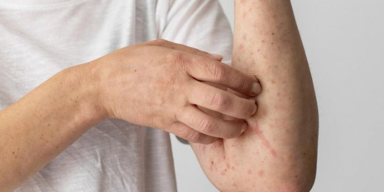 Prof. Zubairi Djoerban Ingatkan Masyarakat tidak Abai dengan Infeksi Monkeypox