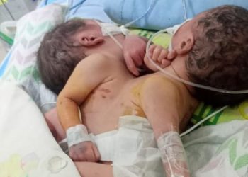 Warga Batu Bara Lahirkan Bayi Kembar Siam Dempet Dada di RSUP Adam Malik Medan