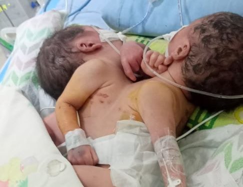 Warga Batu Bara Lahirkan Bayi Kembar Siam Dempet Dada di RSUP Adam Malik Medan