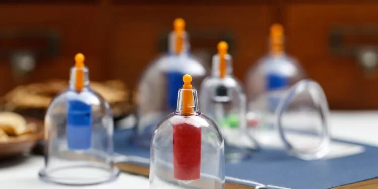 Hukum Bekam dalam Islam, Bolehkah?